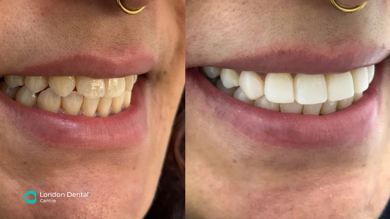Smile makeover result